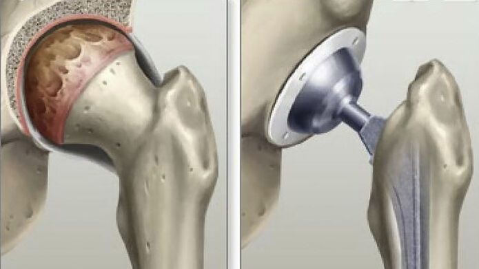 Hip arthroplasty performed in the late stages of coxarthrosis