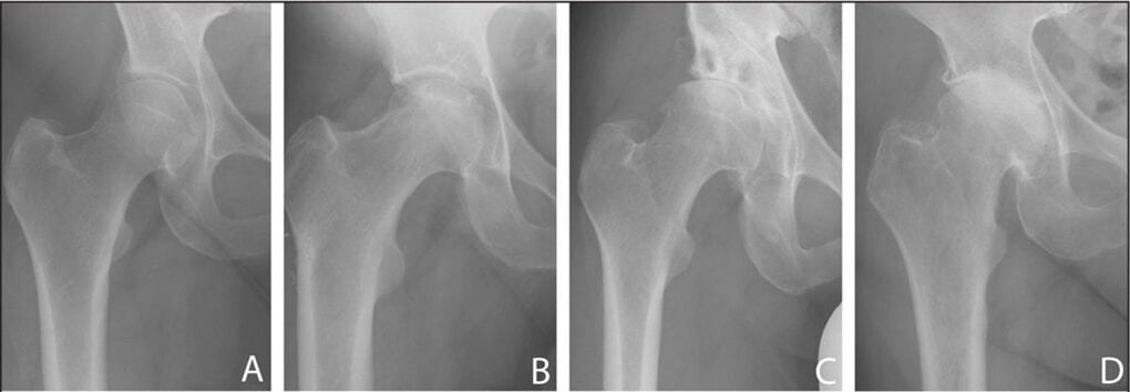 Stages of development of osteoarthritis of the hip joint on an x-ray