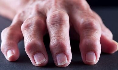 What is the difference between arthritis arthritis
