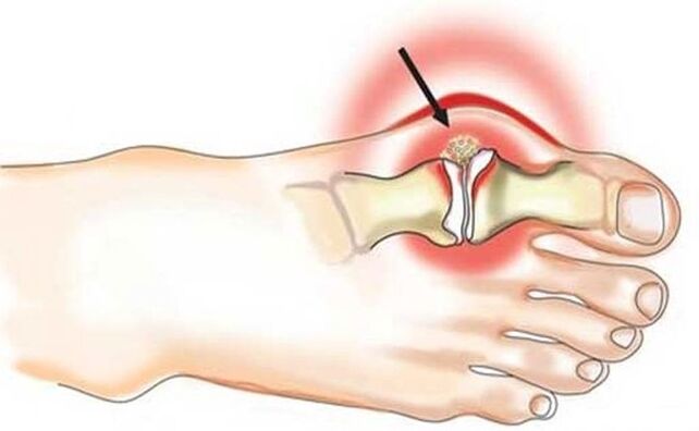Inflammation of the joint between the big toe and foot due to arthritis
