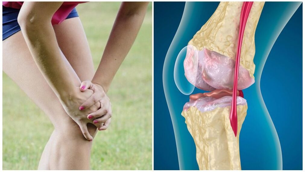osteoarthritis symptoms