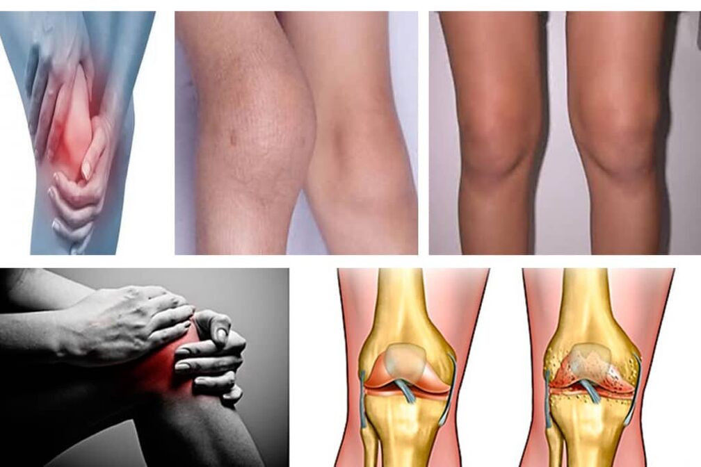 osteoarthritis what is it