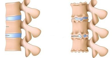 How to recognize the presence of Lombar osteochondrosis